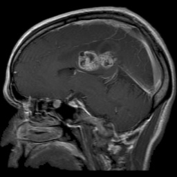 Glioma Tumor