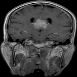 Meningioma Tumor